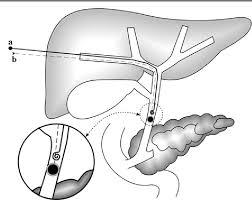 • transhepatic vascular procedure (i.e. Figure 1 From Percutaneous Transhepatic Biliary Drainage And Occlusion Balloon In The Management Of Duodenal Stump Fistula Semantic Scholar
