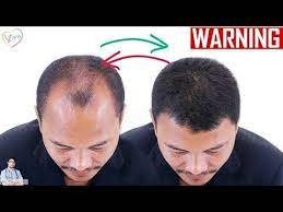 If you have curly hair, style your hair with foam to get that glorious texture and backcomb it. Ccca Alopecia Scarring Alopecia Friendly Black Hair Styles Sydneynicolehair Com Skyler Hairstyl Reverse Hair Loss Male Pattern Baldness Natural Hair Loss