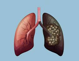 Image result for Lung Cancer