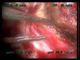 Never use bean bag filling, corn, stockings, foam rubber nor cut up rags. Dacron Patch Aortoplasty For Descending Thoracic Aortic Pseudoaneurysm Youtube