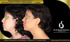 Otorrinolaringología y Cirugía plástica facial en Clínica Campeche