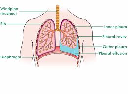 Normally, a small amount of fluid is present in the pleura. Pleural Effusion Macmillan Cancer Support