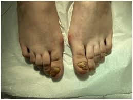 Image result for Onychogryphosis feet