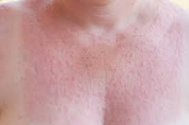 Image result for Radiation Dermatitis