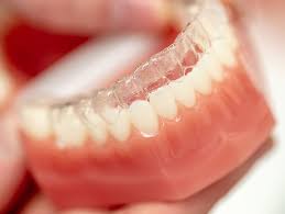 Jeder wünscht sich gesunde, schöne und vorallem gerade zähne. Unsichtbare Zahnkorrektur Mit Schienen Aligner Dr Raphael Hoehr Kieferorthopade Borken Dr Raphael Hoehr Kieferorthopade Borken