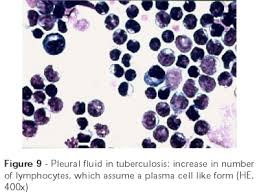 Find updated content daily for pleural mesothelioma Scielo Brasil The Value Of Cytology And Pleural Biopsy In The Differential Diagnostic Of Nonspecific Pleural Effusions The Value Of Cytology And Pleural Biopsy In The Differential Diagnostic Of Nonspecific