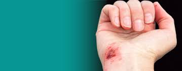 Image result for Wound