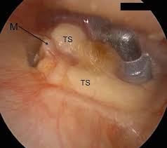 Image result for Myringosclerosis