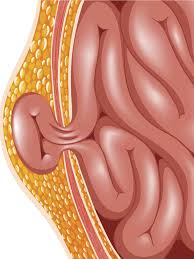Check spelling or type a new query. Some Hernias Won T Go Away Without Treatment