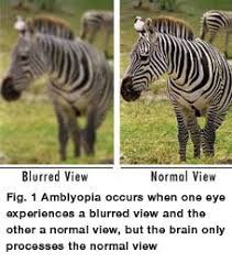 Visual Explanation Of Amblyopia Vision Therapy Eye Health Vision Eye