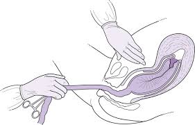 Image result for Active Management of Labor