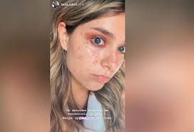 Laura tobón está que no se cambia por nadie, pues el éxito en el estreno de 'la voz kids' la tiene dichosa, sumado a la bella etapa que vive. Laura Tobon Sufrio Dano En El Rostro Por Cambio Hormonal La Fm