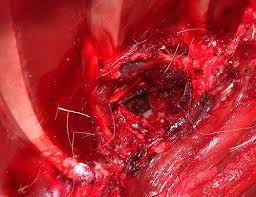 At those ranges the bullet entry starts to look like a knife wound (slit wound) because of the entry the bullet fired from a 50 cal weighs in at around 700 grains. 50 Cal Bullet Wound On Human What Damage Does A 50 Bmg Do On Animals Sniper S Hide Bullet Would Do Minimum Damage But If You Were Hit With