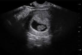 We did not find results for: Pregnancy Test Ultrasound Pregnancy Test