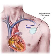 Image result for Internal Cardiac Defibrillator