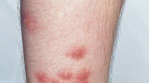 Image result for Cimex lectularius bites