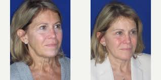 Anthony Corrado, DO, Board Certified Facial Plastic Surgeon