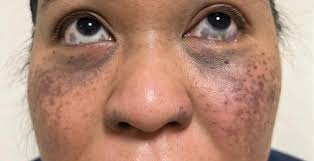Image result for nevus sclerae