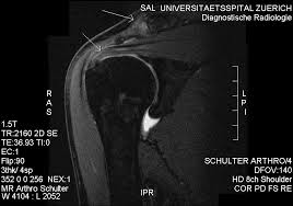 Impingement Wikipedia