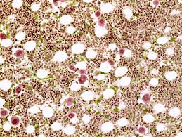 Yellow bone marrow is located in the hollow cavity of long bones. Bone Marrow Anatomy Function And Treatment