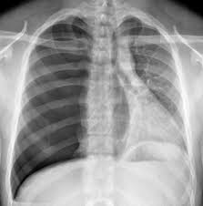 Abreu, i., guedes, m., duro, r., lopes, s., maciel, j., santos, l. Lung Hyperlucency Chest