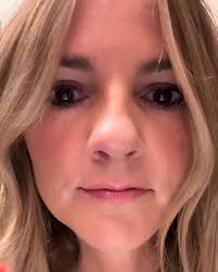 Little slice of life lately! Nose: About 3 weeks out from Septoplasty, scar  tissue removal surgery (dog bite repair) … I have a pretty high pain  tolerance. This thing took me out