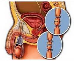Procedimiento quirúrgico para esterilización masculina. Vasectomia Ecured