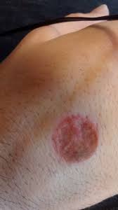 Ringworm is a fungal condition which affects the skin and produces a rash. Adv Advice Thread 15653963