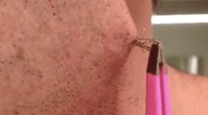 It will not have a visible head and may be red, white, or yellow. Ingrown Hair Cysts Deep Causes Symptoms Get Rid Removal Pubic Hair Cyst Large Pictures Under Skin Infected Treatment