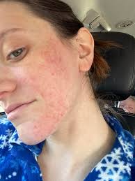 What could be causing my skin rash during pregnancy?