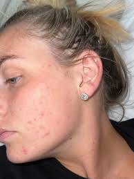 Just a little reminder that yes—even your esthetician experiences  breakouts! 🙋‍♀️✨ It's not always easy to feel comfortable in your skin  when acne shows up, but you're not alone. With the right