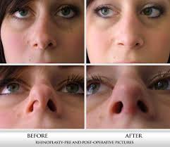Insurance claims for a nose job rhinoplasty, or any other plastic surgery, can be a very expensive affair. Nose Surgery Rhinoplasty Beverly Hills Ca Fadi Chahin Md Facs
