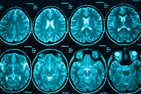 Mosquitoes turn into infected whenever. West Nile Virus Mri Scans Uncover Evidence Of Long Term Neurological Damage Infectious Diseases Hub