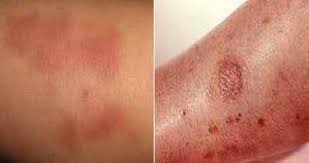 Ce service gratuit de google traduit instantanément des mots, des expressions et des pages web du français vers plus de 100 autres langues. Piqure D Araignee Gonflement Bouton Dans Le Lit La Nuit