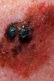 Melanoma is a skin cancer usually caused by ultraviolet rays from the sun or tanning beds. Stage 4 Melanoma Survival Rate Pictures And Treatment