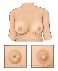 科普｜乳头内陷会带来哪些问题？哪些需要手术矫正治疗？