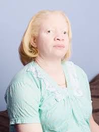 Here's What Albinism Really Looks Like