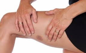 If the problem is not addressed at this point, the skin can become discolored and take. Hemosiderin Staining Symptoms Causes And Treatments
