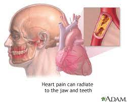 Jaw Pain And Heart Attacks Medlineplus Medical Encyclopedia Image