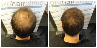 It gently cleanses your hair while. Haarpuder Prohair Clinic