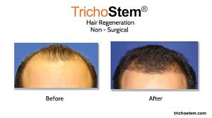 January 31, 2020 by thysista filed under health & wellness, opinion, weekly columns. Limits Of Hair Transplants And Hair Loss Drugs Finasteride And Minoxidil