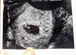 At 6 week ultrasound, the embryo is barely 0.25 inches, which is the size of a sweet pea. Is It Possible Doctor Could Of Missed Twin At 6 Week Ultrasound Glow Community