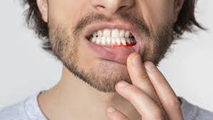 Take a mouthful of lukewarm water and swish it around the tooth. Tooth Infection Pure Dental Health Atlanta Ga