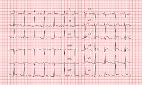 Les infos, chiffres, immobilier, hotels & le mag. Pericardite Aigue Ecg