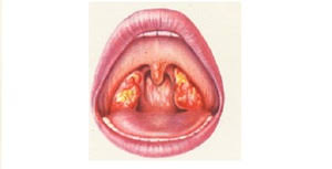 In gat sunt pete rotuinde bine conturate ca niste boabe de linte. Pete Albe In Gat Pete Albe In Gatul Unui Copil