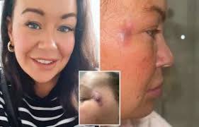 My lips exploded with pus after £60 botched fillers pierced a blood vessel  and left me permanently disfigured