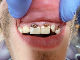 Small to medium cavity once the cavity eats through the dentin, your dentist needs to intervene. How To Fix A Cavity In Front Tooth Teethwalls
