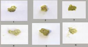 Image result for acholic stools human