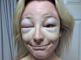Woman Left Looking Like Swollen Monster After Allergic Reaction To Heatwave Sun Mirror Online