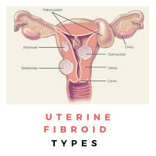 Fibroids Are Non Cancerous Tumors That Appear In The Tissues Around The Womb There Are Four Types Of Fibroid Intramural This Is Fibroids Intramural Cervix
